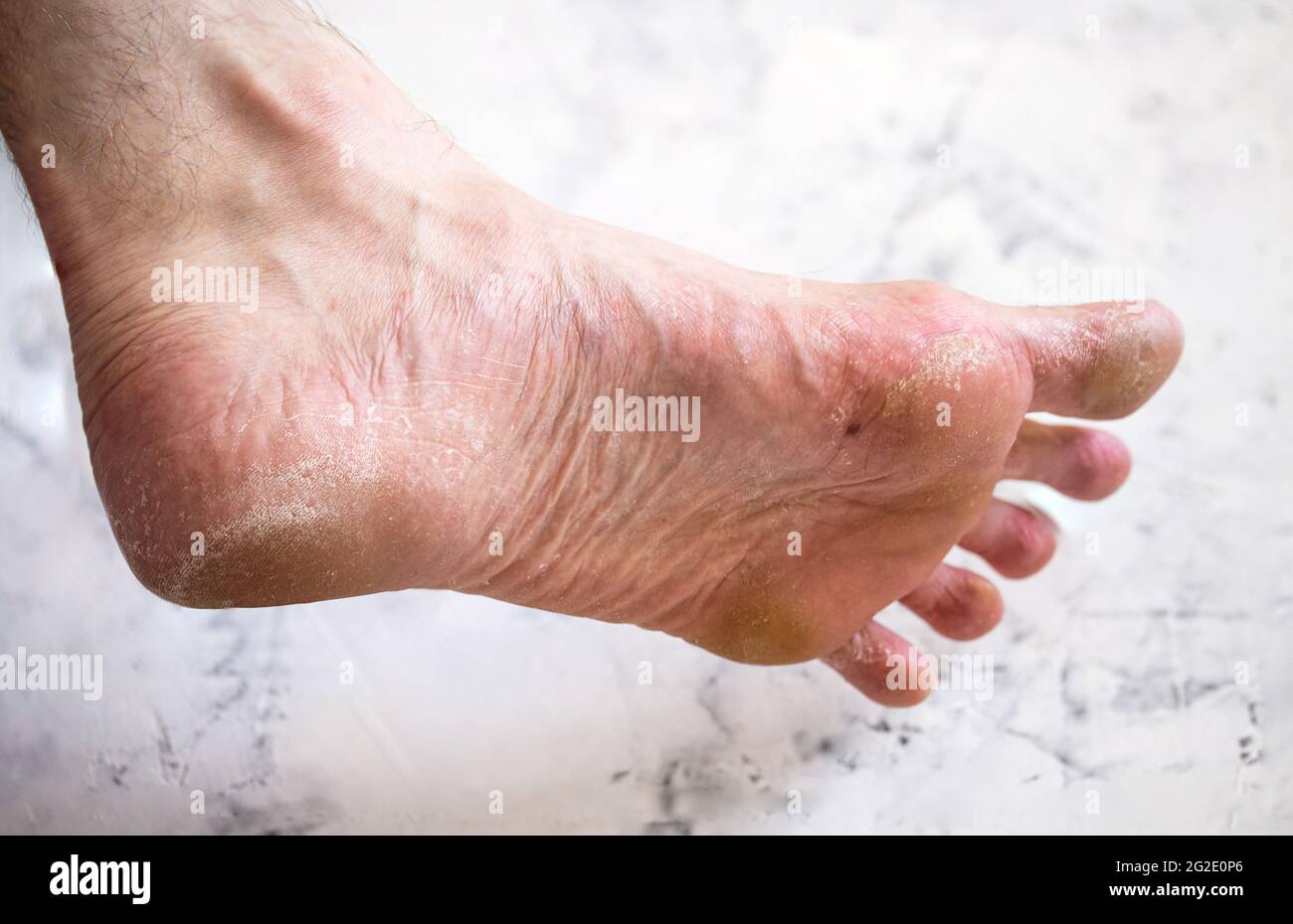 La malattia sulla gamba dell'uomo. Piede asciutto. Foto Stock