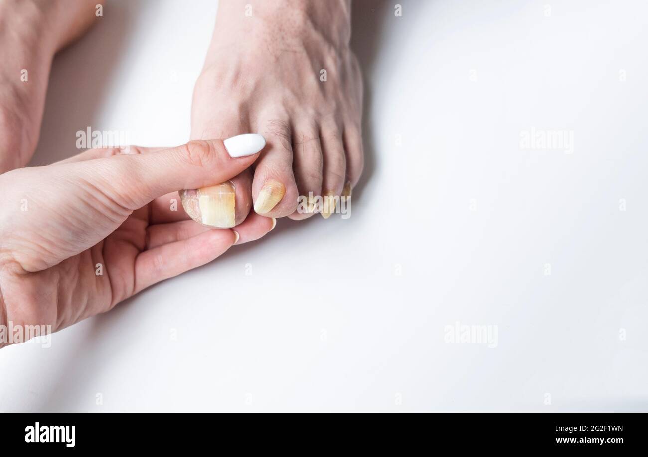 I piedi dell'uomo con le unghie lunghe infettate dal Fungo Foto Stock