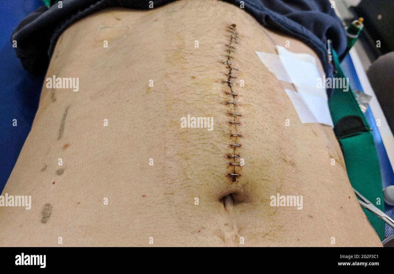 Incisione del cancro rettale dopo l'intervento chirurgico. Ferita gastrointestinale . Intervento di ostruzione del cancro rettale Foto Stock