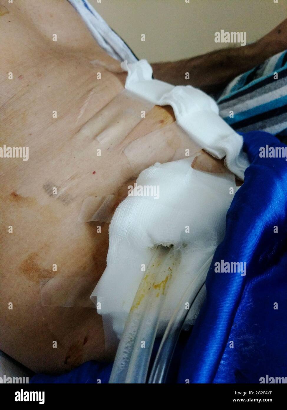 Uomo dopo la chirurgia del cancro colorettale, il torace di drenaggio del torace pneumotorace collegato a un flacone riempito di liquido e ad altri tubi di drenaggio Foto Stock