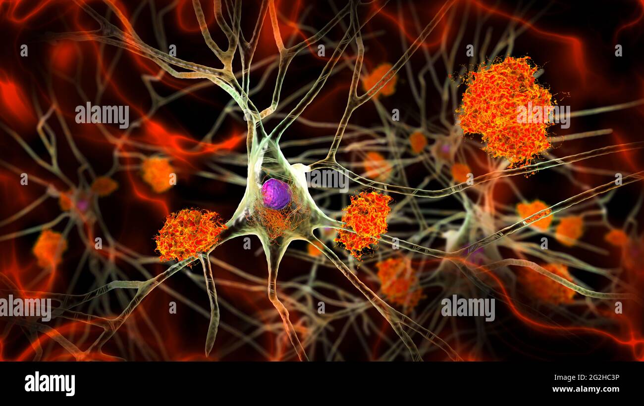 Cellule nervose colpite dal morbo di Alzheimer, illustrazione Foto Stock