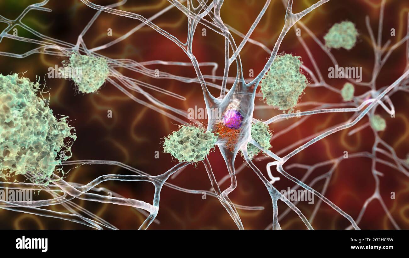 Cellule nervose colpite dal morbo di Alzheimer, illustrazione Foto Stock