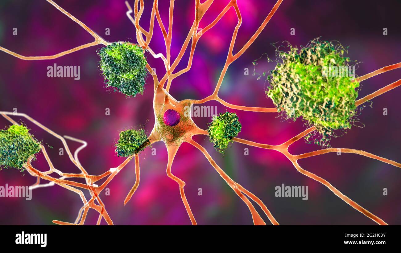 Cellule nervose colpite dal morbo di Alzheimer, illustrazione Foto Stock