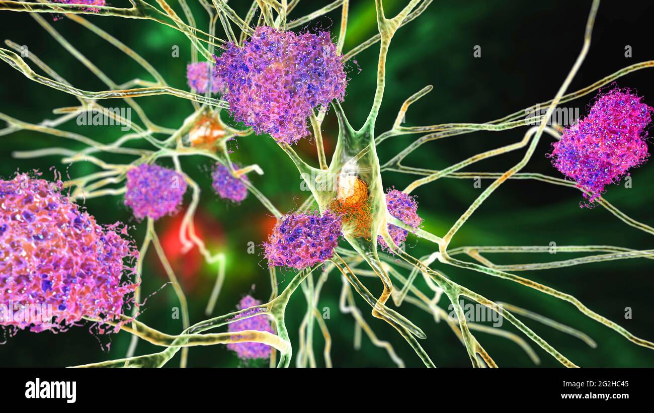 Cellule nervose colpite dal morbo di Alzheimer, illustrazione Foto Stock
