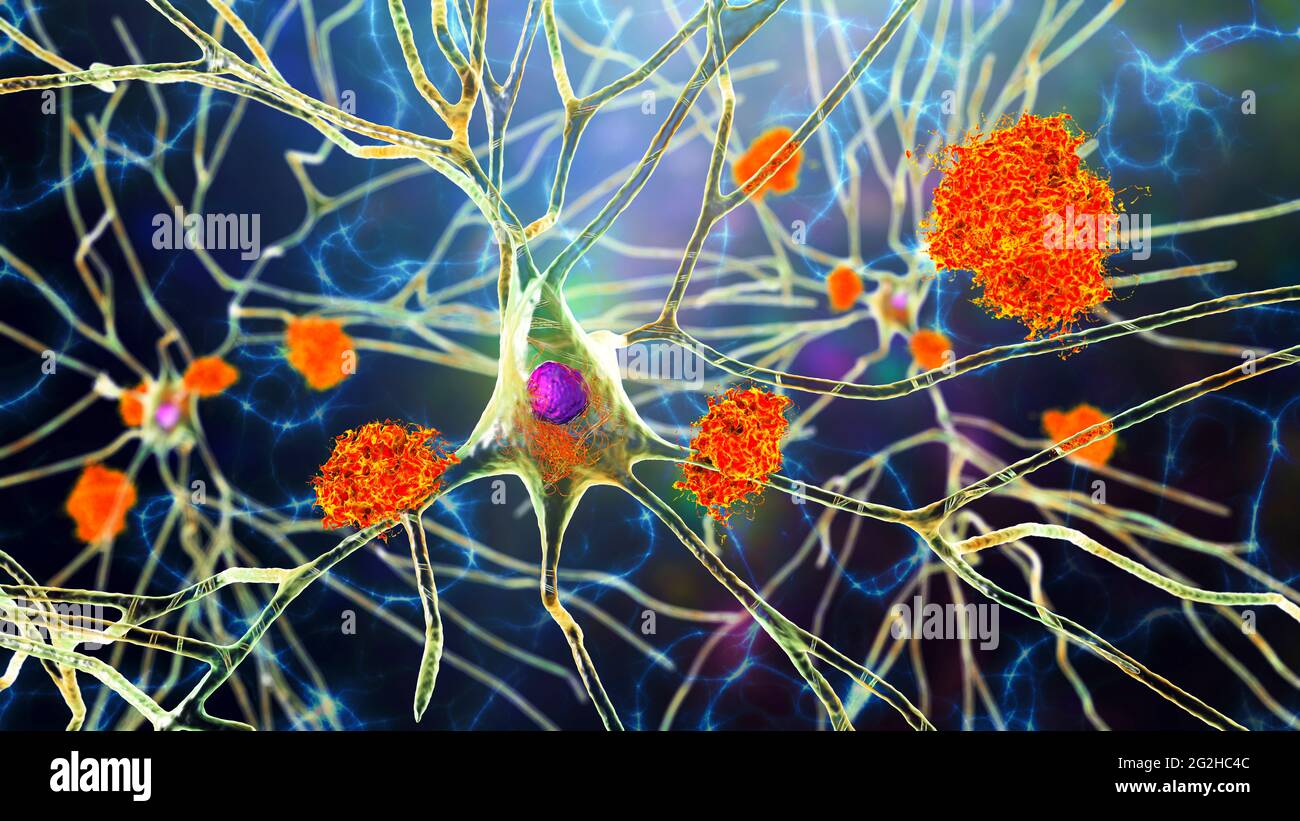 Cellule nervose colpite dal morbo di Alzheimer, illustrazione Foto Stock