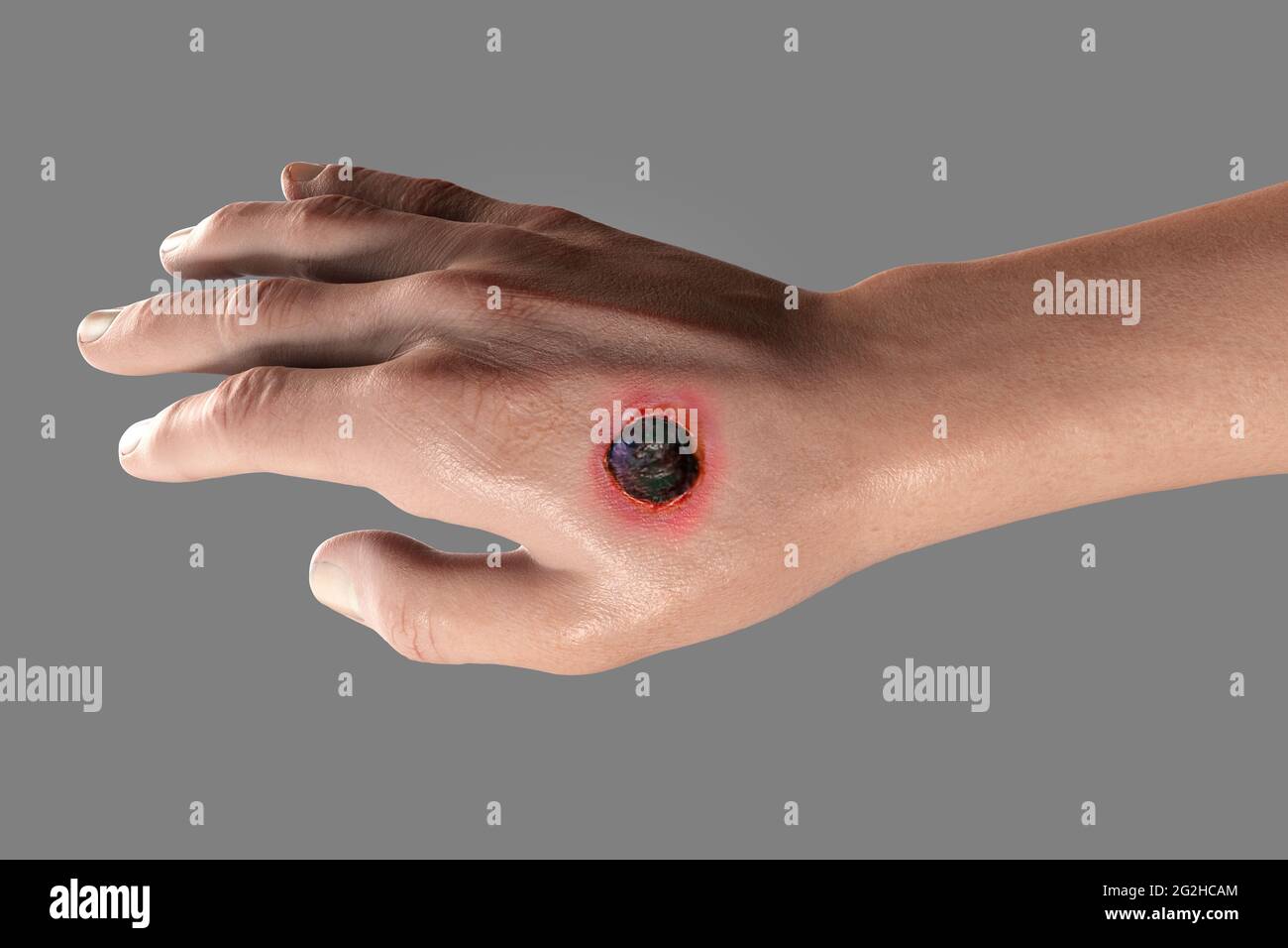Antrace cutaneo, illustrazione Foto Stock
