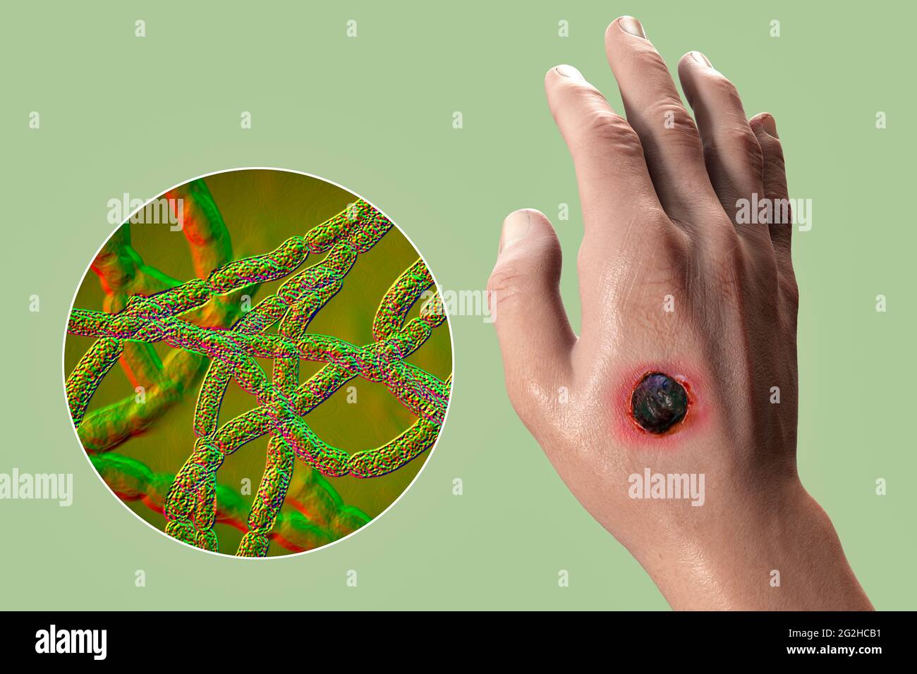 Antrace cutaneo, illustrazione Foto Stock