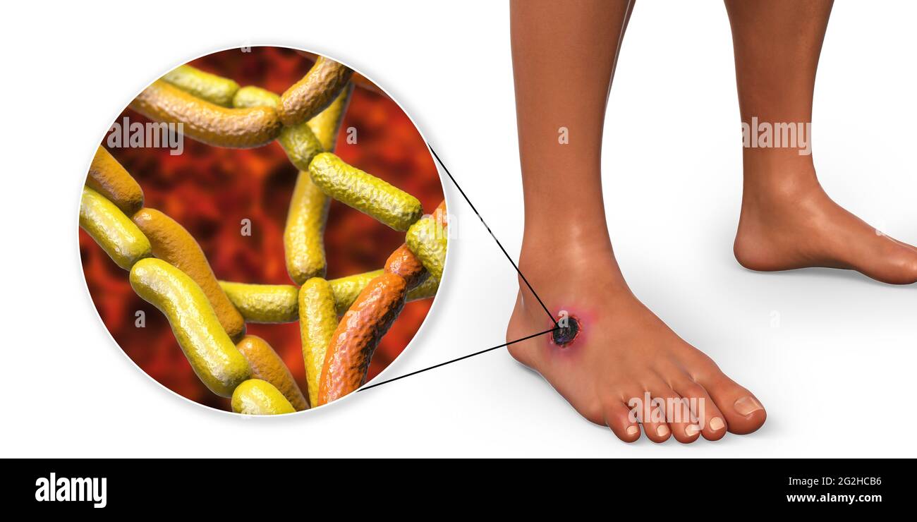 Antrace cutaneo, illustrazione Foto Stock