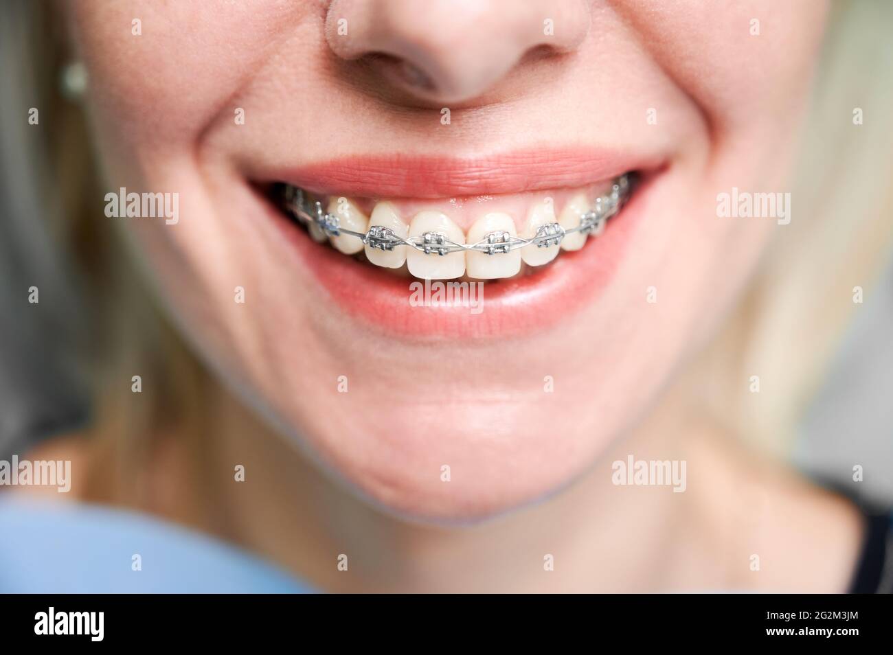 Primo piano di donna con un sorriso affascinante che mostra denti bianchi con staffe ortodontiche. Paziente di sesso femminile che mostra i risultati del trattamento con i rinforzi dentali. Concetto di trattamento ortodontico e odontoiatria. Foto Stock