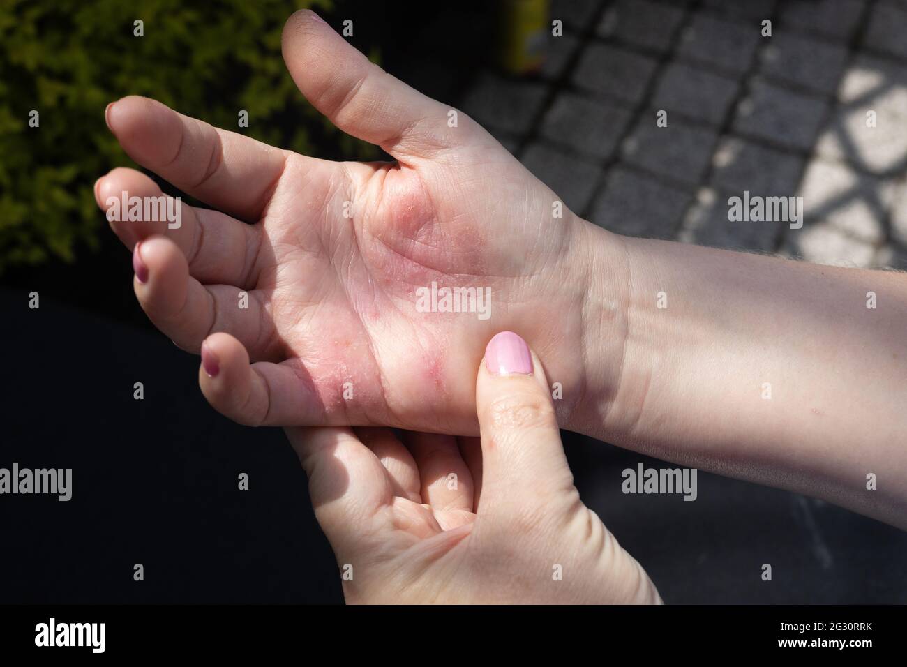 Grave eczema allergico sulle mani. Pelle rossa, incrinata con vesciche.  Donna sta graffiando la sua mano Foto stock - Alamy