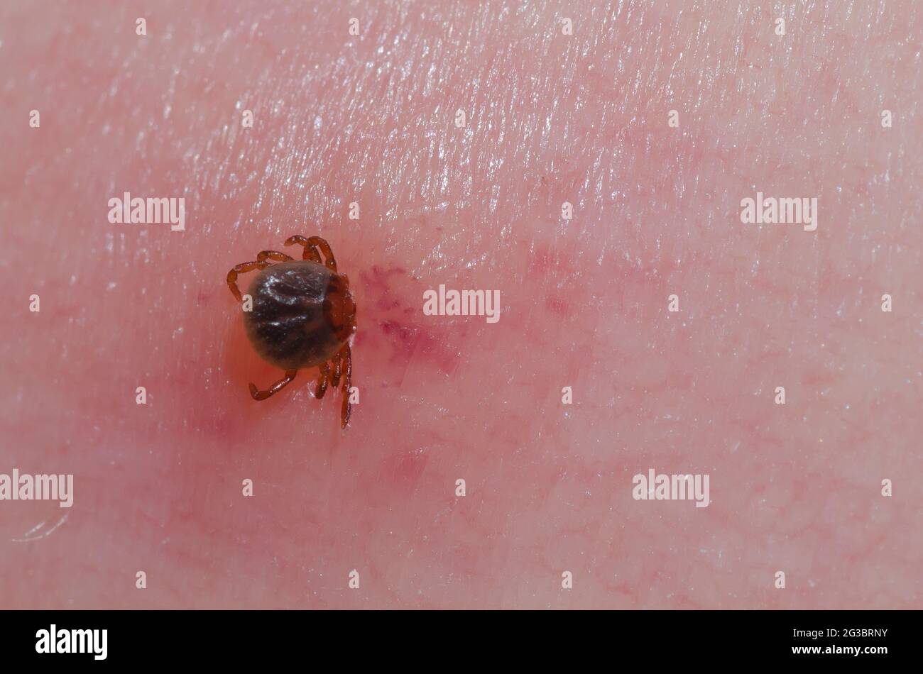 Lone Star Tick, Amblyomma amicanum, ninfa attaccata alla pelle umana Foto Stock
