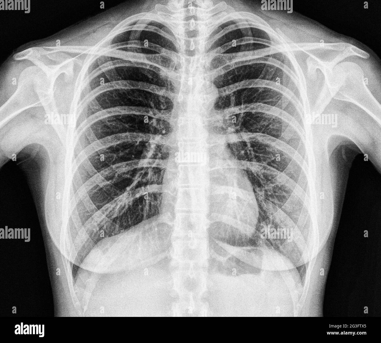 Immagine a raggi X di umana toracica sana Foto Stock