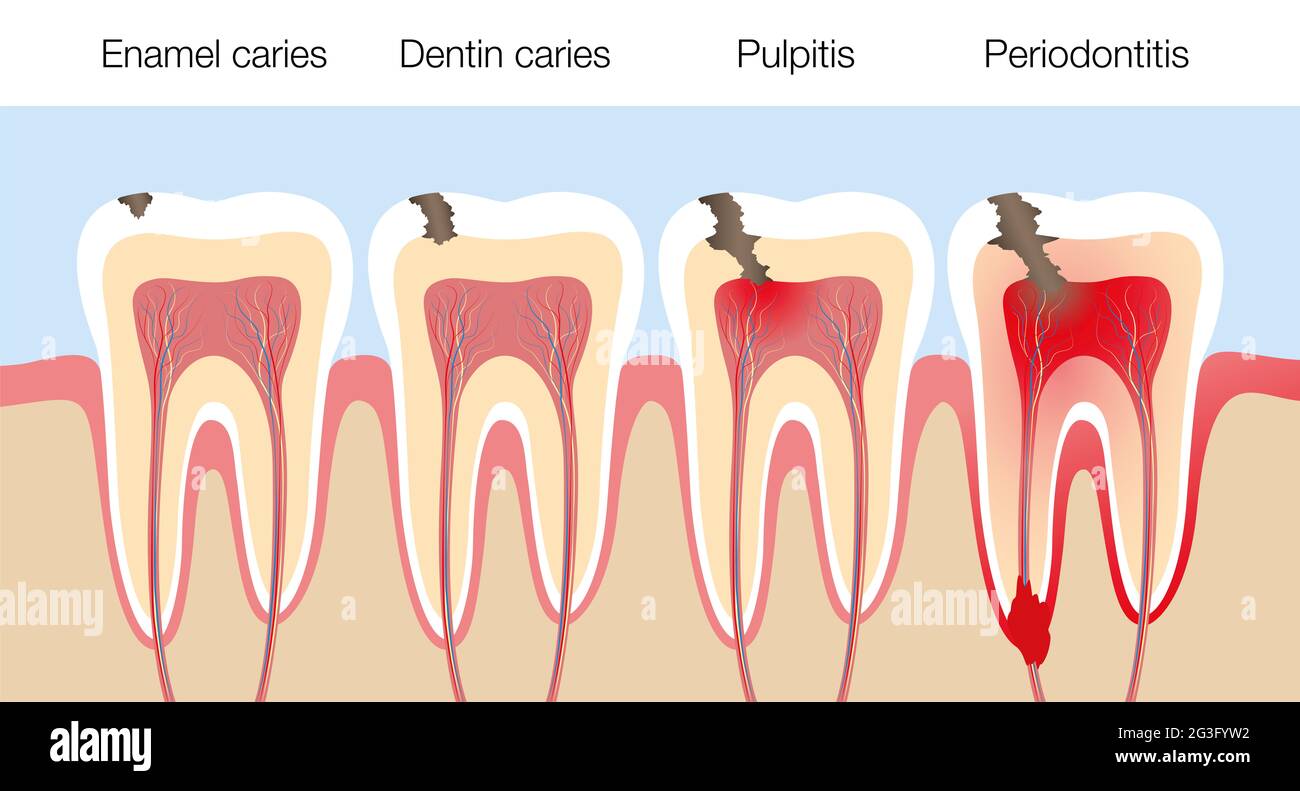 Denti con fasi carie, sviluppo di decadimento dentale con smalto e carie dentina, pulpite e periodontite. Foto Stock