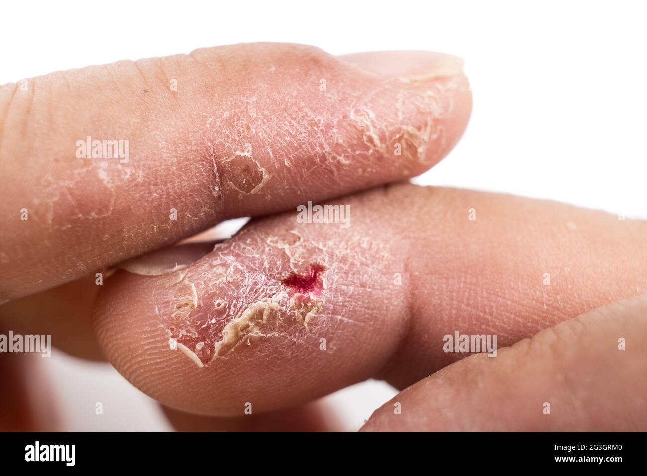 Closeup di pelle secca dolorosa infiammata danneggiata sul dito Foto Stock