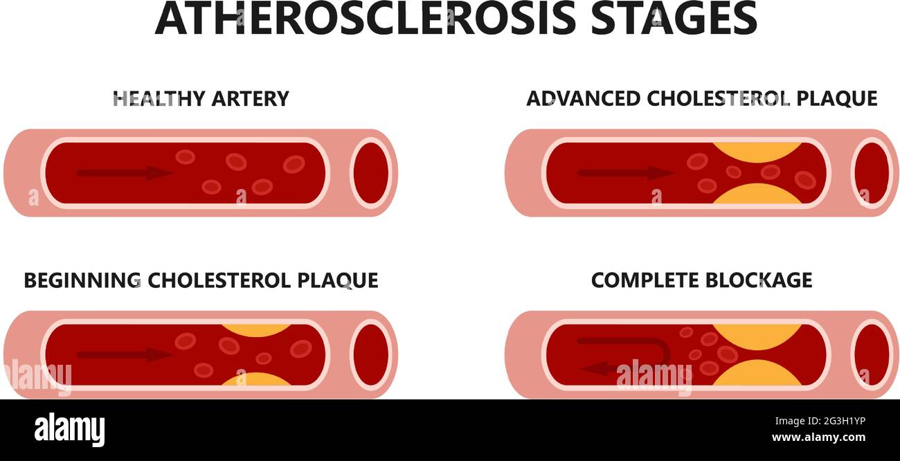 Stadi di aterosclerosi. Arterie sane e malsane. Placca di colesterolo iniziale, placca di colesterolo avanzato, blocco completo. Illustrazione Vettoriale