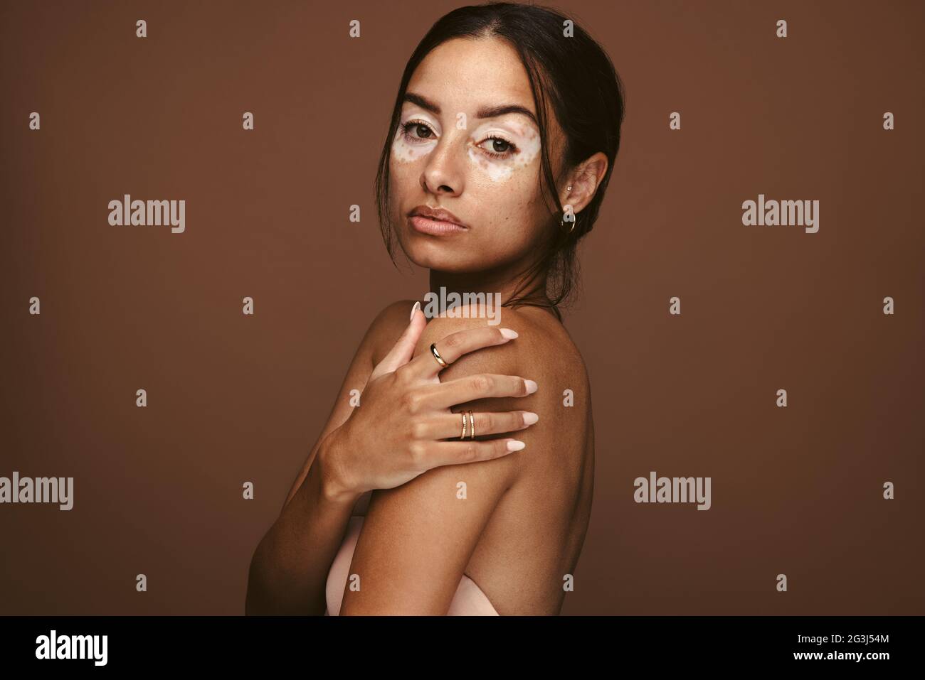Vista laterale ritratto di donna con vitiligo. Primo piano di donna con malattia della pelle. Foto Stock