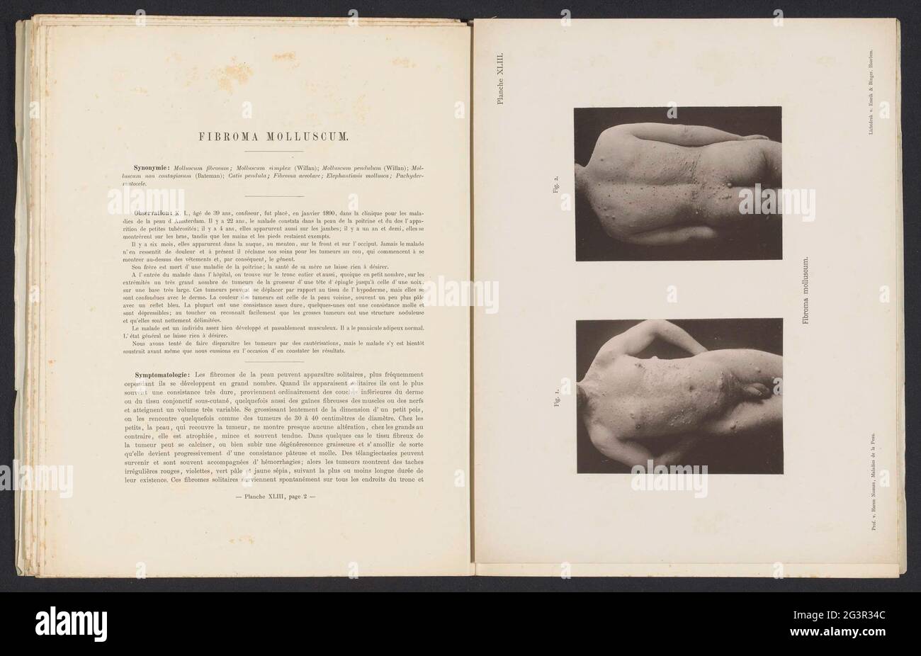 Pazienti affetti dalla malattia della pelle 'Fibroma Molluskum'; Fibroma Molluskum. . Foto Stock
