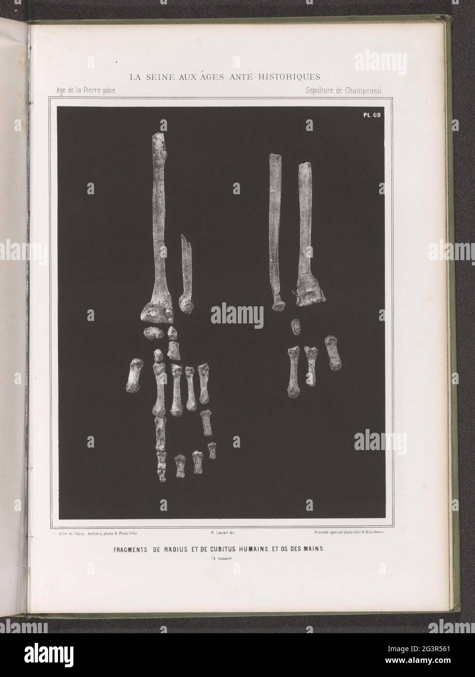 Frammenti dell'elevazione, della gamba del raggio e delle ossa dal braccio e dalla mano umani; frammenti di Radius et de Cubitus Humains, et os des Mains. 1/2 natura. . Foto Stock