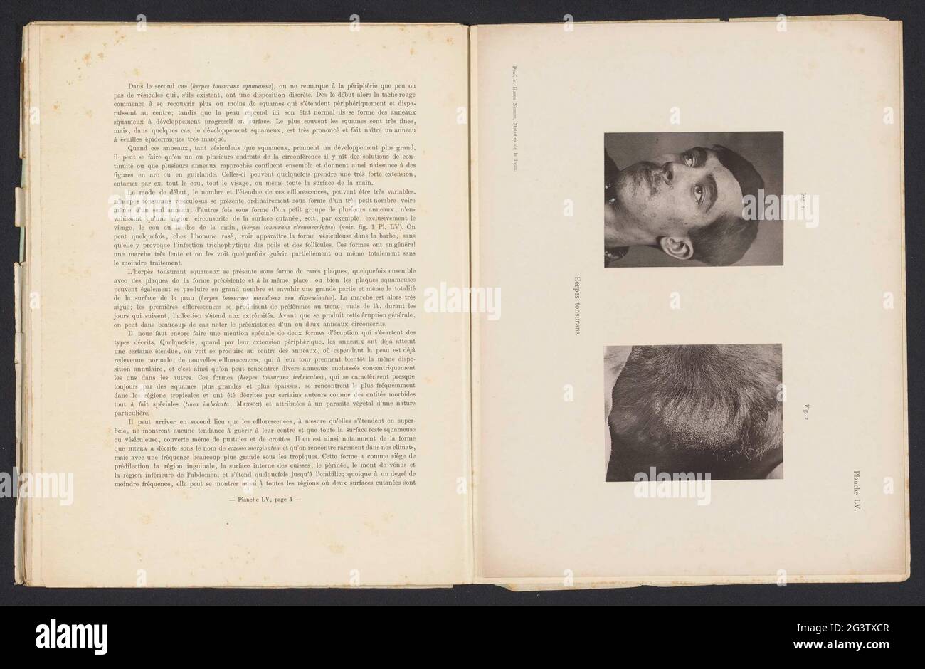 Pazienti affetti dalla malattia della pelle 'Herpes Tonsurans'; Herpes tonsurans. . Foto Stock