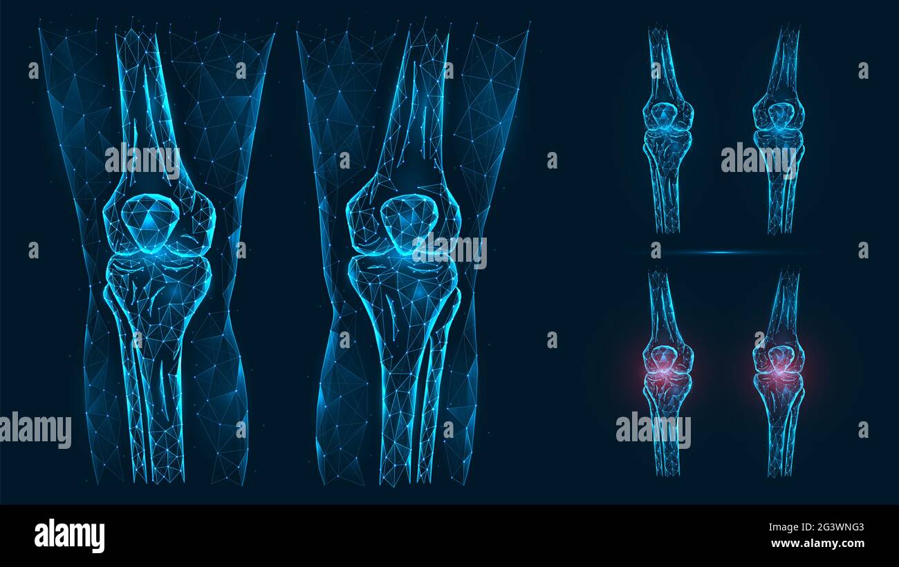 Illustrazione poligonale astratta dell'anatomia del ginocchio umano. Malattia, dolore e infiammazione delle articolazioni del ginocchio isolato su sfondo blu Foto Stock