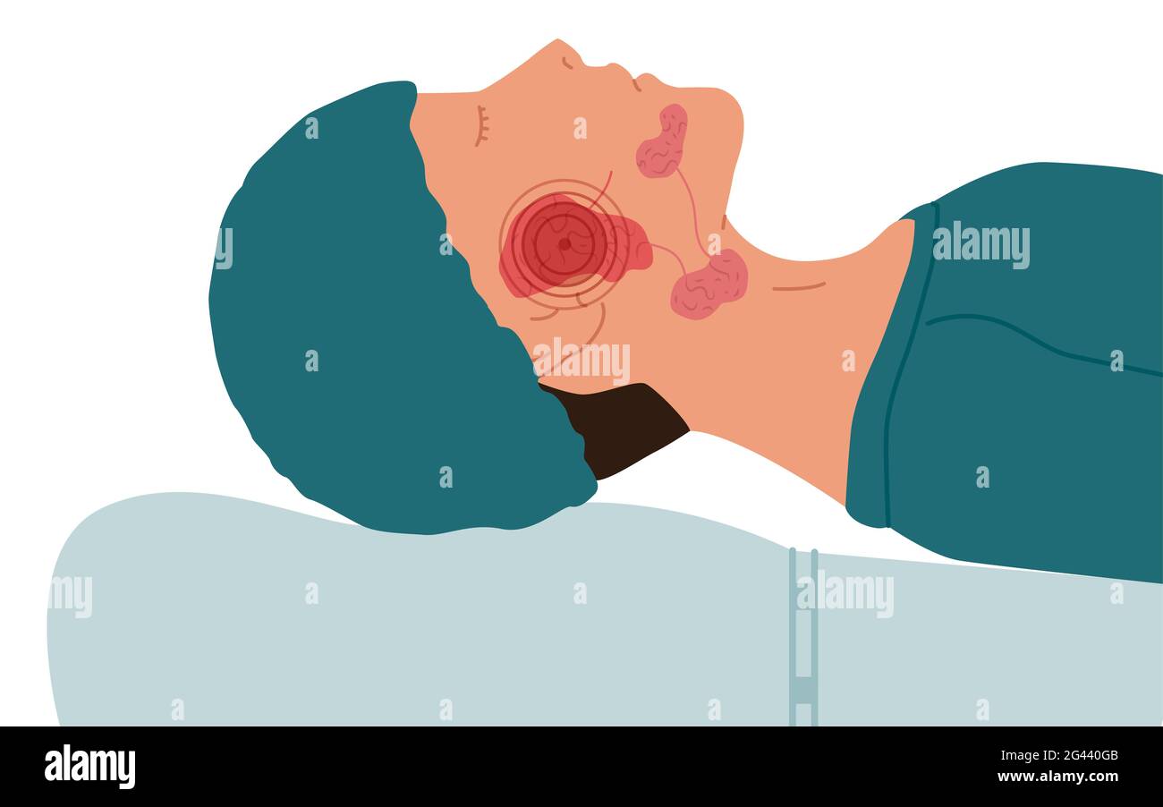 Un paziente con una ghiandola salivare parotide malata. Illustrazione vettoriale della sialolitiasi. Foto Stock