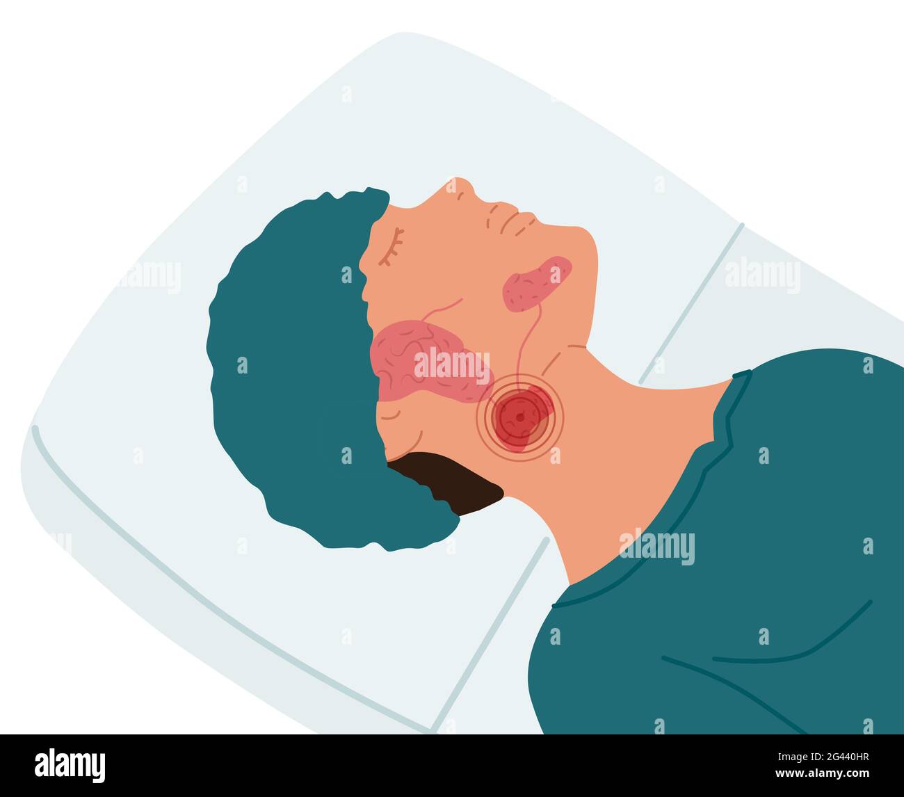 Un paziente con una ghiandola salivare submandibolare malata. Illustrazione vettoriale della sialolitiasi. Foto Stock