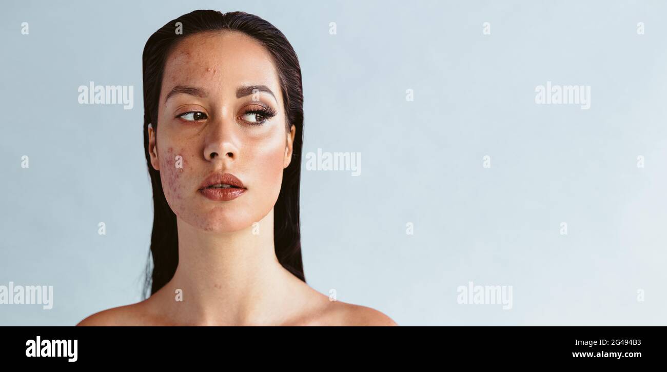 Donna con infiammazione dell'acne sul viso con trucco parziale. Donna che usa il make up per coprire il problema dell'acne. Foto Stock