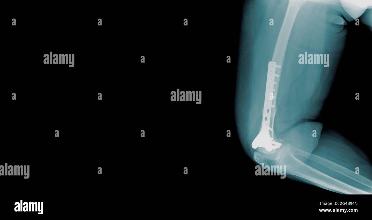 immagine radiografica del design dello striscione di fissaggio del femore distale Foto Stock