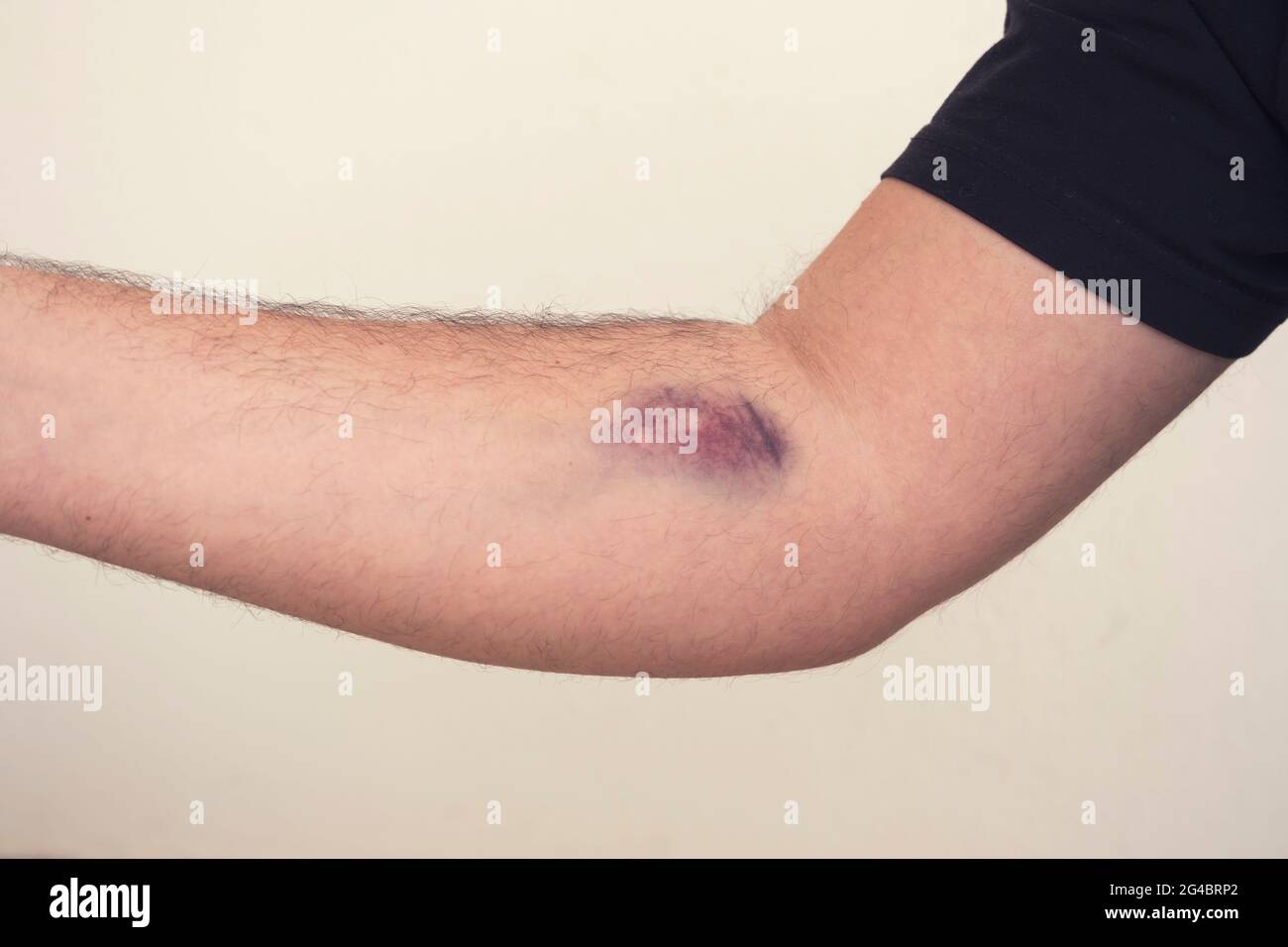 Lividi dalla raccolta del sangue su sfondo bianco. Immagine ravvicinata Foto Stock
