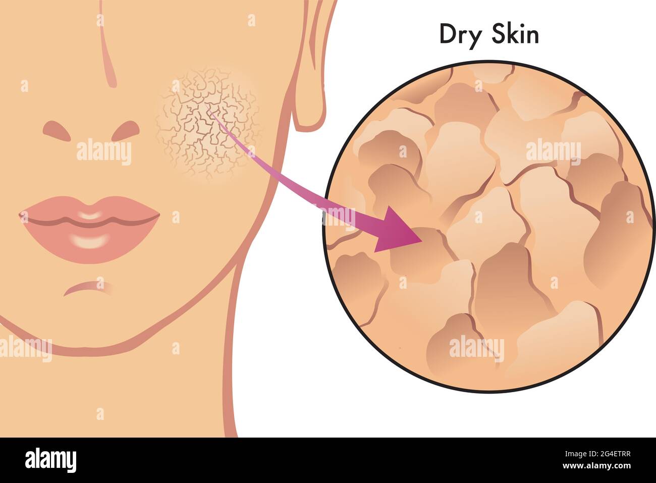 Illustrazione medica dei sintomi della pelle secca. Illustrazione Vettoriale
