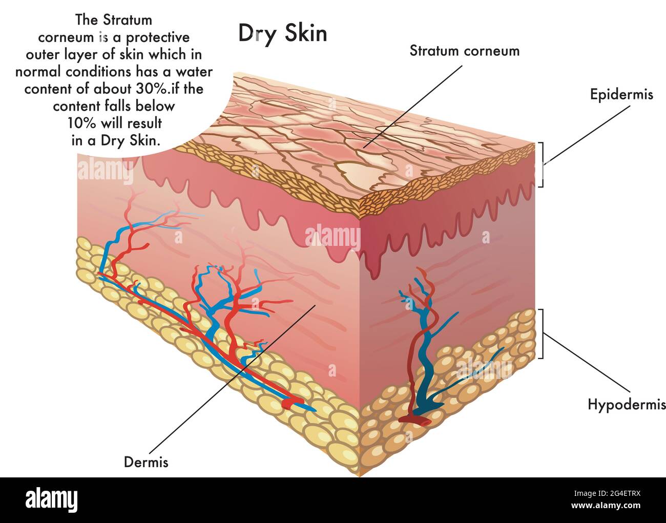 Illustrazione medica dei sintomi della pelle secca. Illustrazione Vettoriale