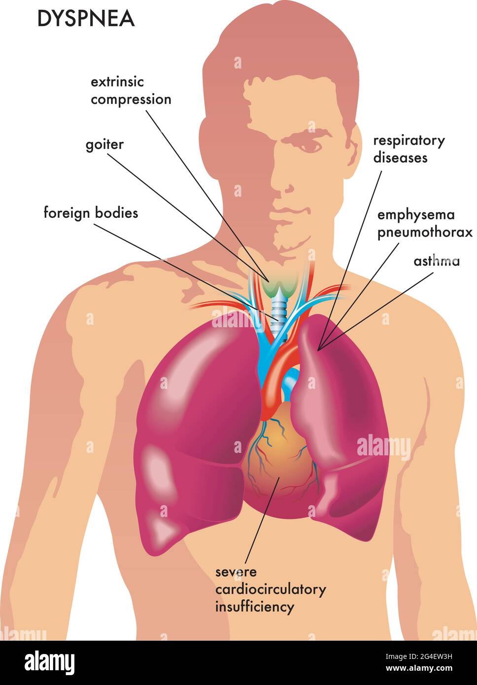 Illustrazione medica delle possibili cause di dispnea. Illustrazione Vettoriale