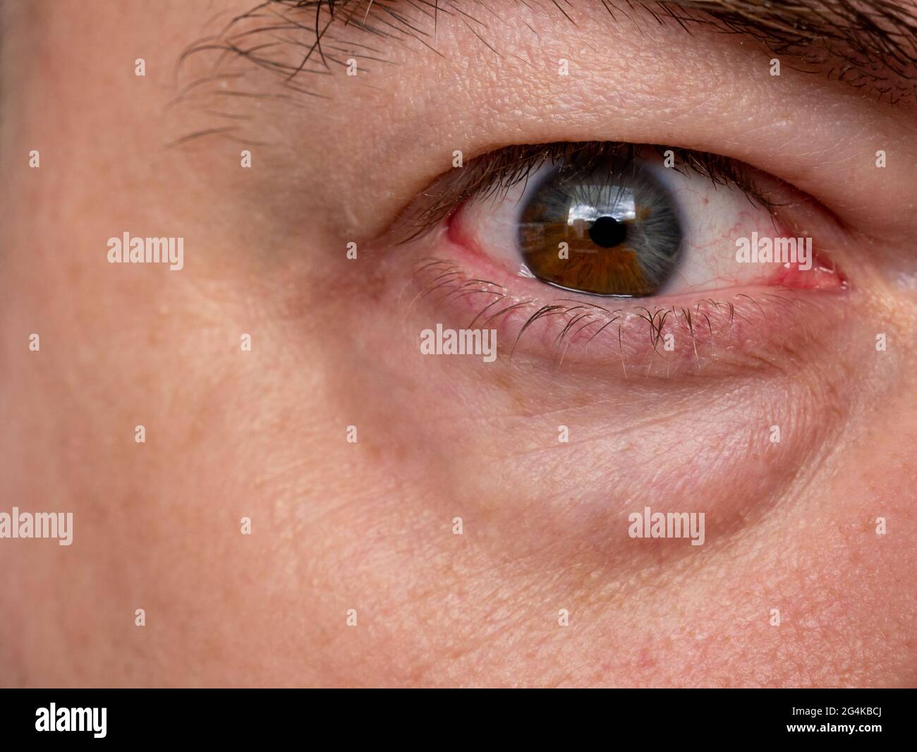 Heterochromia iridis - due colori diversi nell'occhio Foto Stock