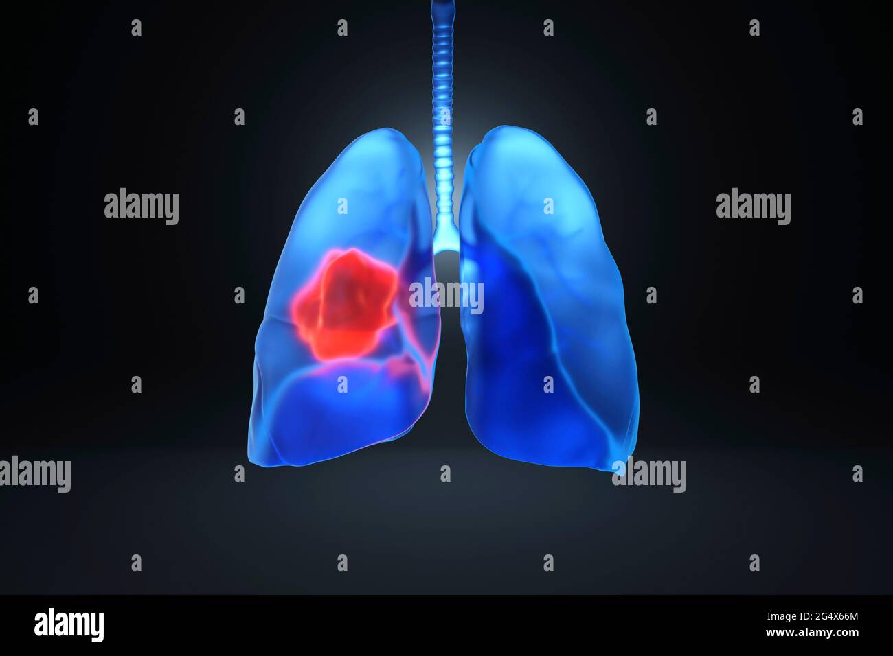 Immagine generata digitalmente dei polmoni con cancro Foto Stock