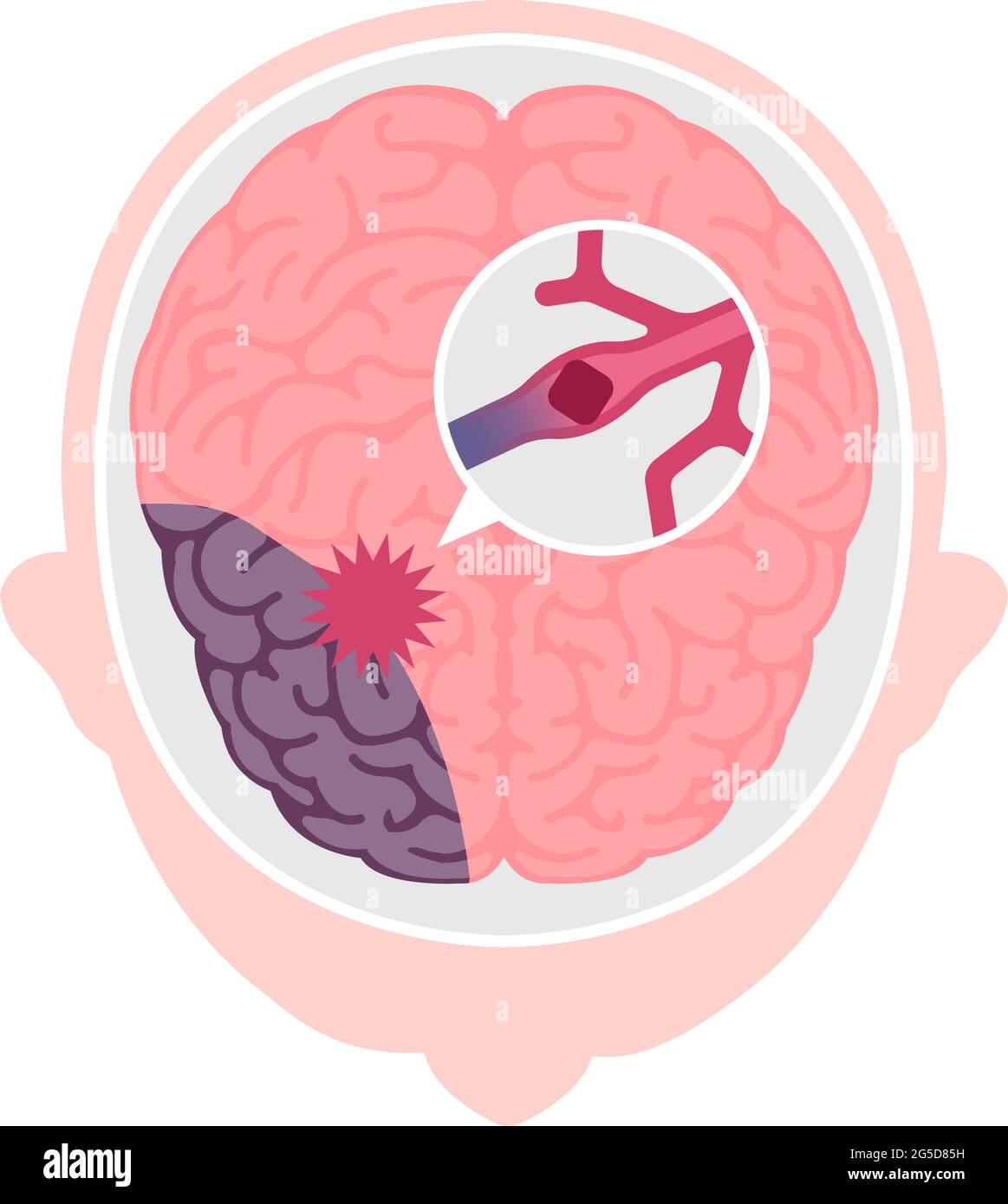 Illustrazione dei tipi di ictus cerebrale umano | infarto cerebrale Illustrazione Vettoriale