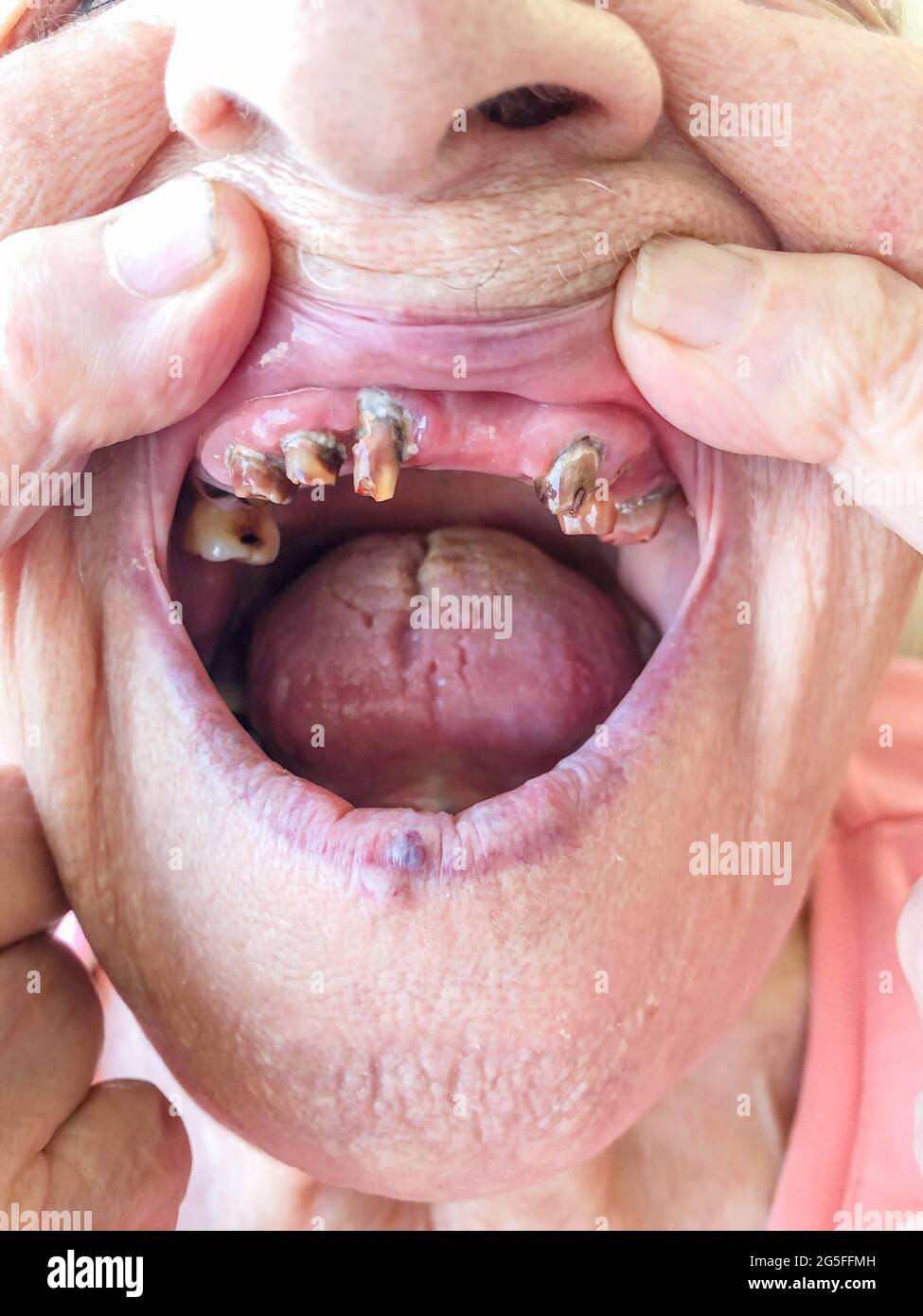 bocca di closeup di una vecchia donna con denti molto cattivi Foto Stock