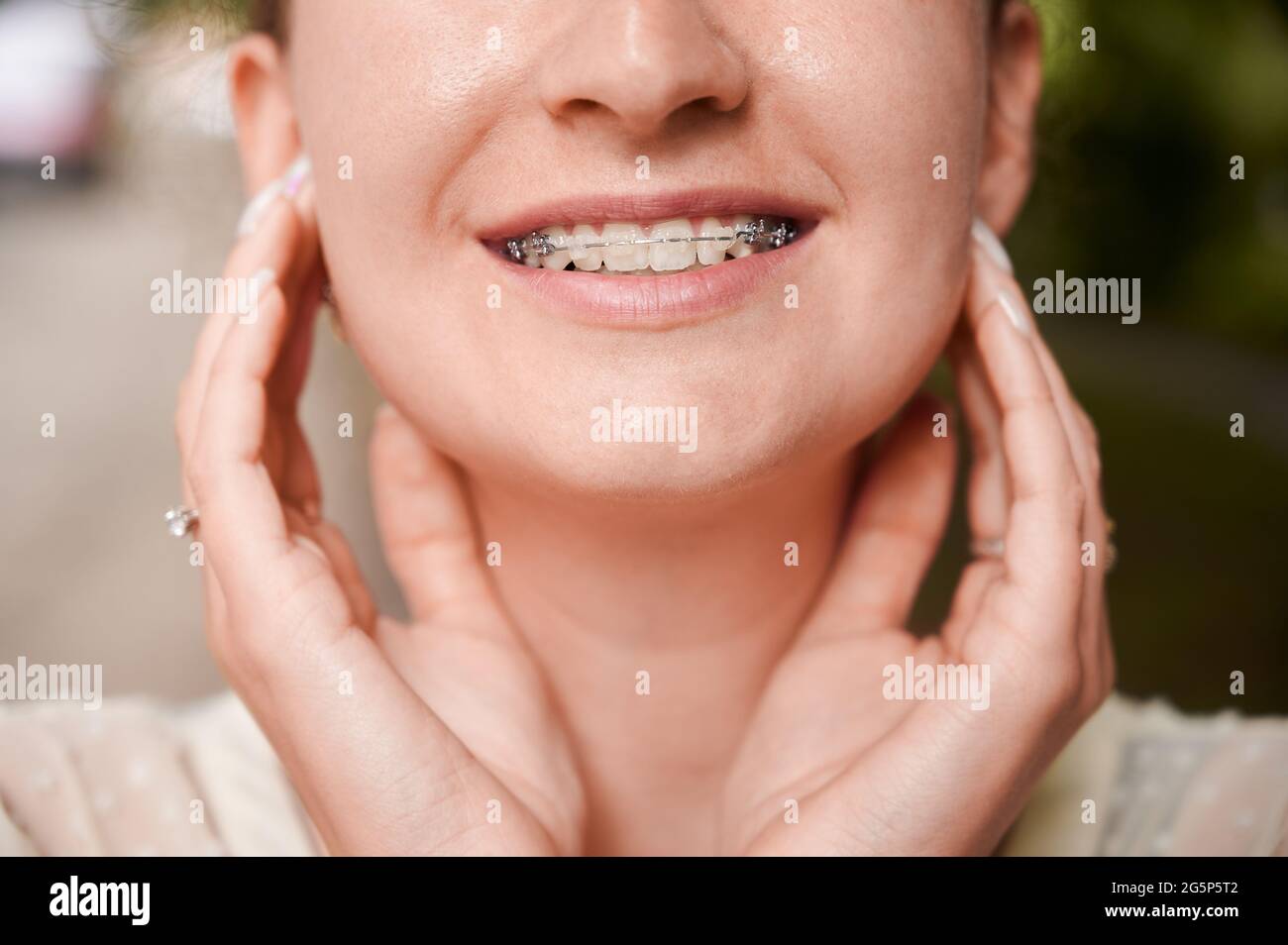 Primo piano di giovane donna allegra con staffe ortodontiche sui denti sorridenti. Paziente che dimostra i risultati del trattamento con i rinforzi dentali. Concetto di odontoiatria, stomatologia e trattamento ortodontico. Foto Stock