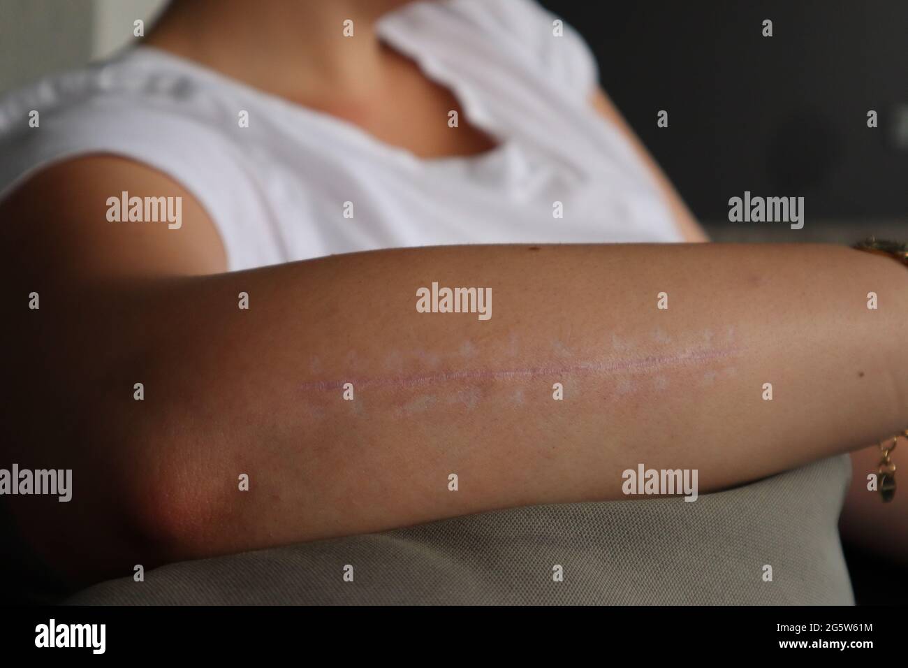 Cicatrice post-chirurgica da avambraccio rotto. Inline skating injury dopo l'intervento chirurgico. Foto Stock