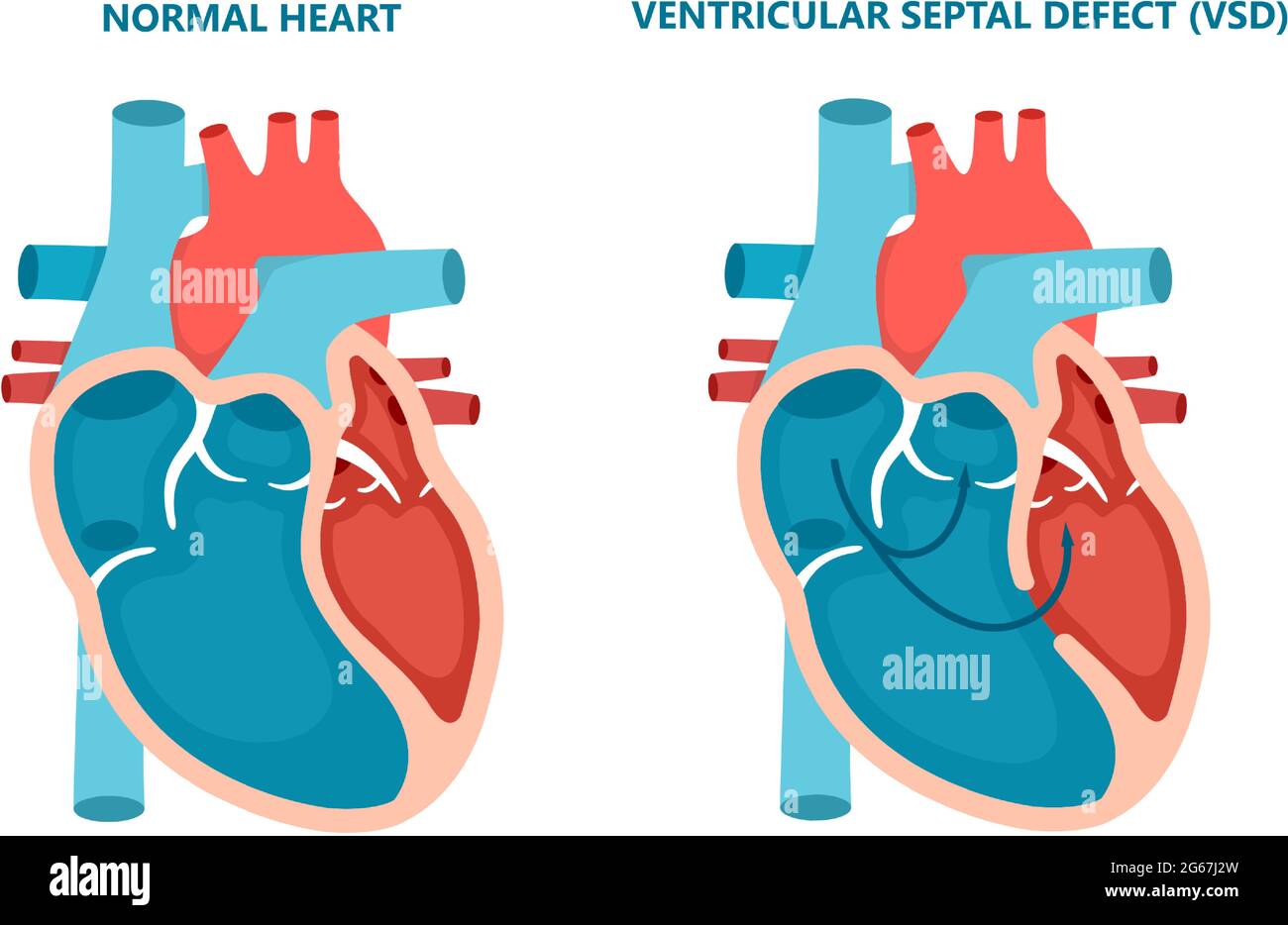 Difetto del setto ventricolare VSD. Malattie del muscolo cardiaco umano sezione trasversale. Concetto di cardiologia. Illustrazione Vettoriale