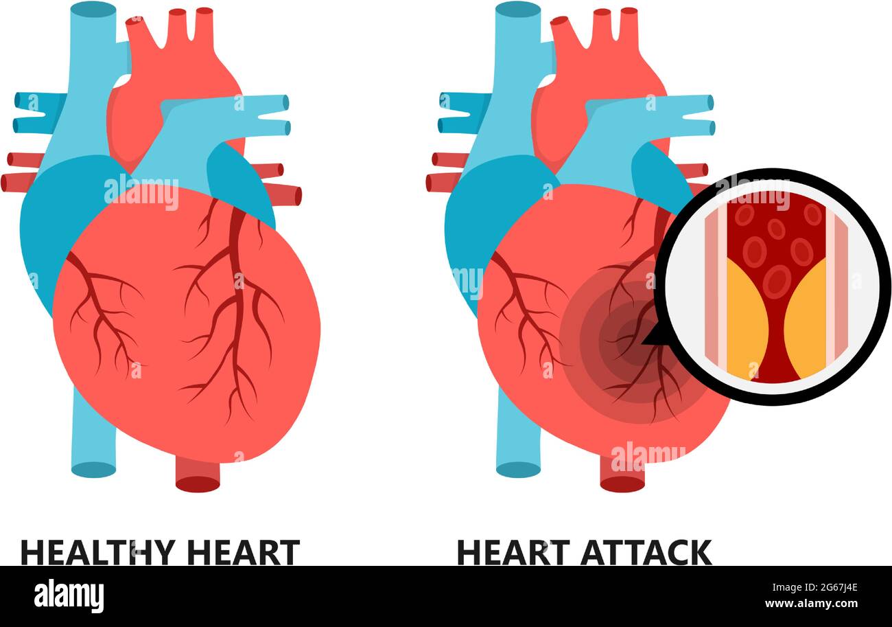 Cuore sano e malsano. Cuore con placca aterosclerotica. Illustrazione Vettoriale