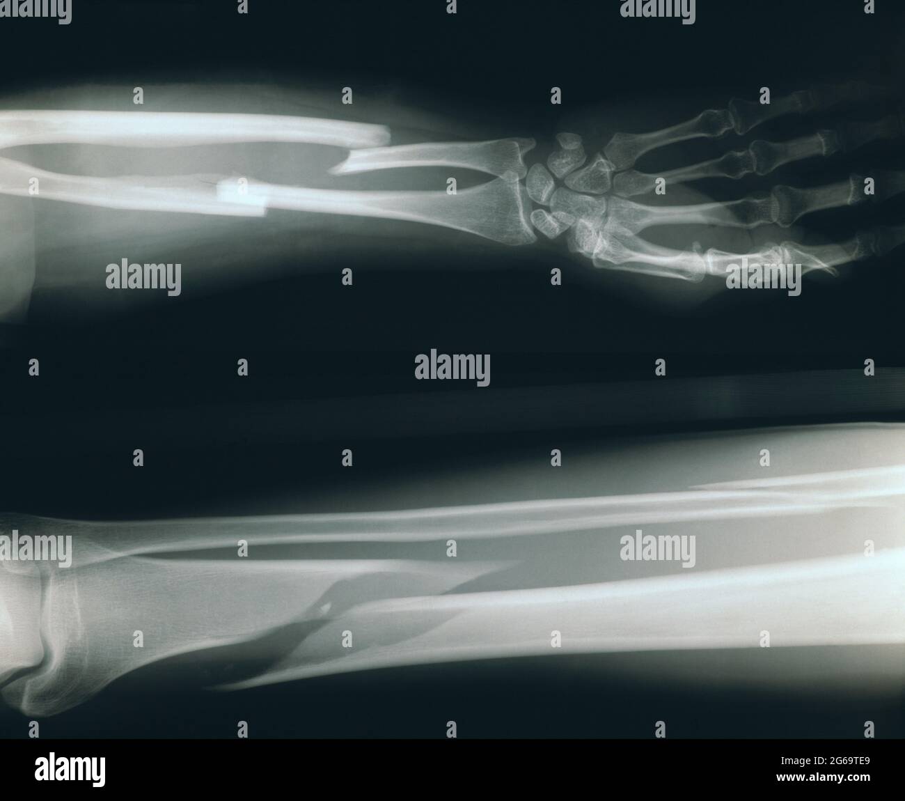 Radiografia. Raggi X medici di gamba e braccio rotti. Foto Stock