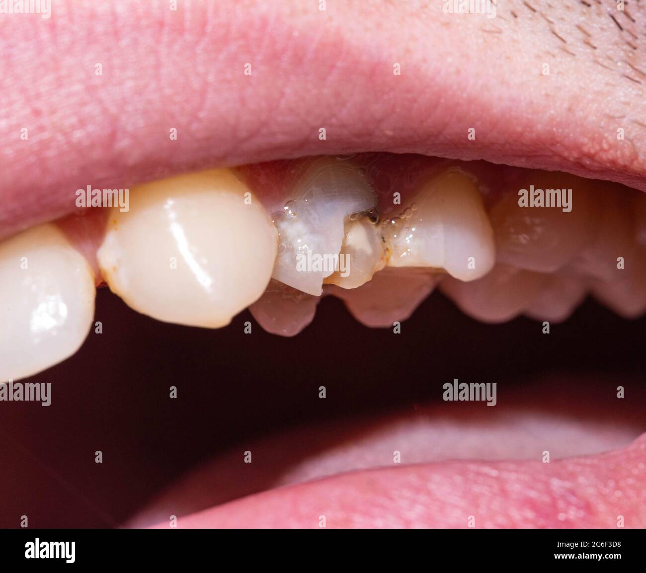 Un dente morto nero in cui un pezzo di smalto del dente è scheggiato via,  una scheggiatura del dente. Il concetto di restauro dentale in odontoiatria  moderna, macro. Ortod Foto stock -
