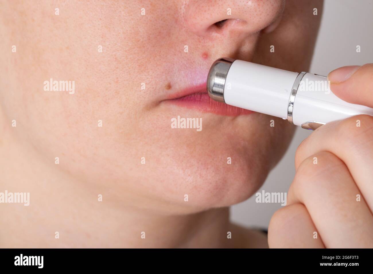 La ragazza tratta infiammata acne rossa sulla pelle del viso con una penna  cosmetica laser, procedura cosmetica. Dermatologo Foto stock - Alamy