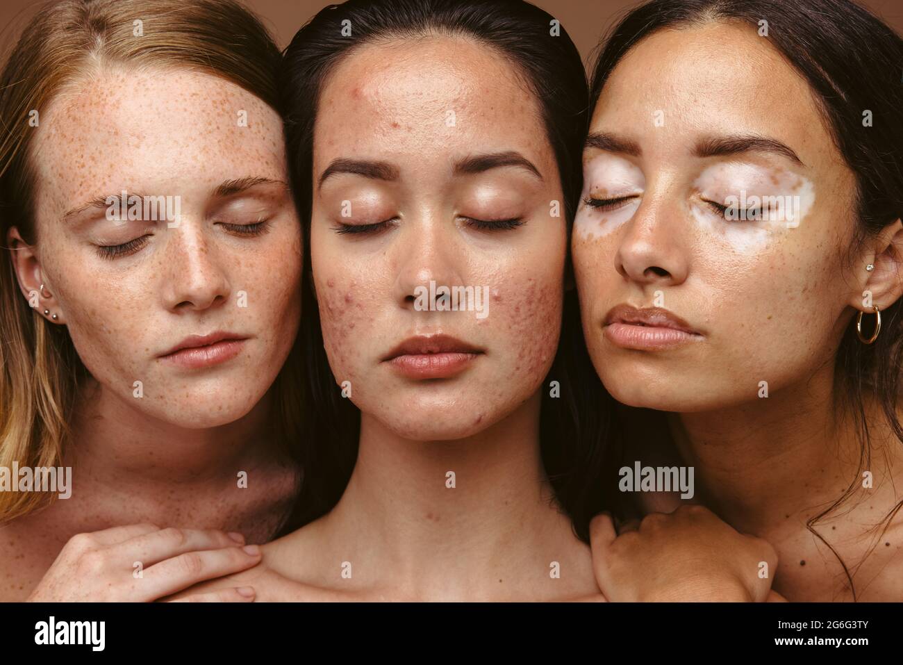 Ritratto di tre donne con problemi di pelle insieme su sfondo marrone. Primo piano di donne che hanno condizioni di pelle con gli occhi chiusi Foto Stock