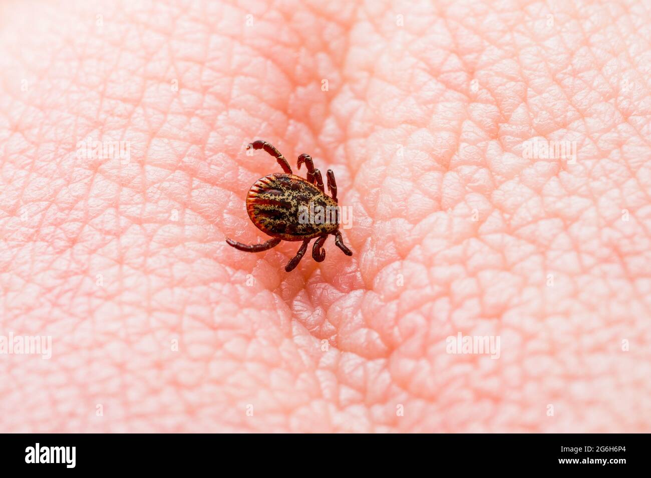 Encefalite infettiva Tick Insect sulla pelle. Encefalite Virus o Lyme borreliosi malattia infetta Dermacentor Tick Arachnid parassita Bite. Foto Stock