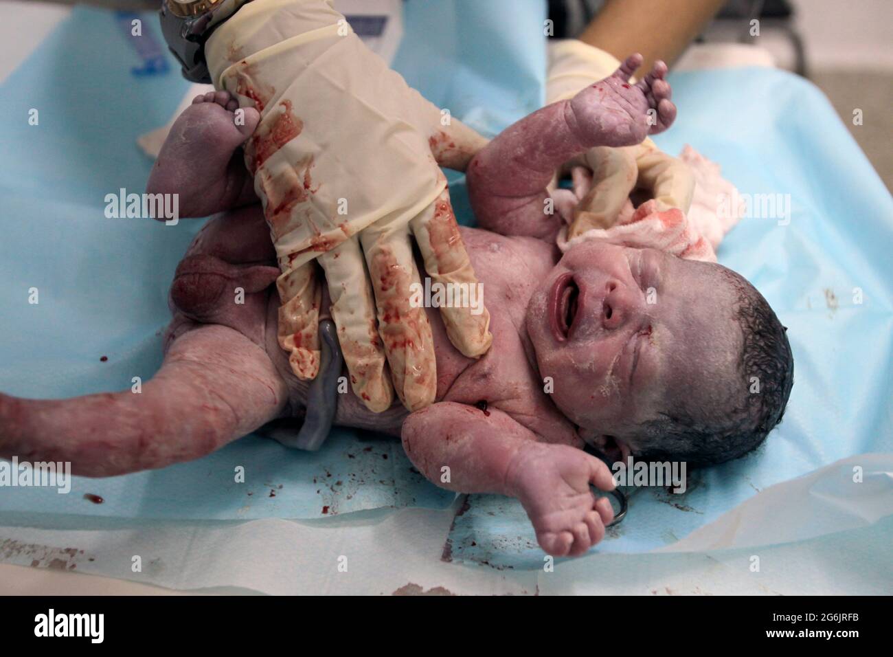 Maracaibo- Venezuela-19-06-2015- maternità Castillo Plaza in Venezuela. Un parto ragazzo da neonato in reparto di lavoro. © JOSE ISAAC BULA URRUTIA / ALAMY S Foto Stock