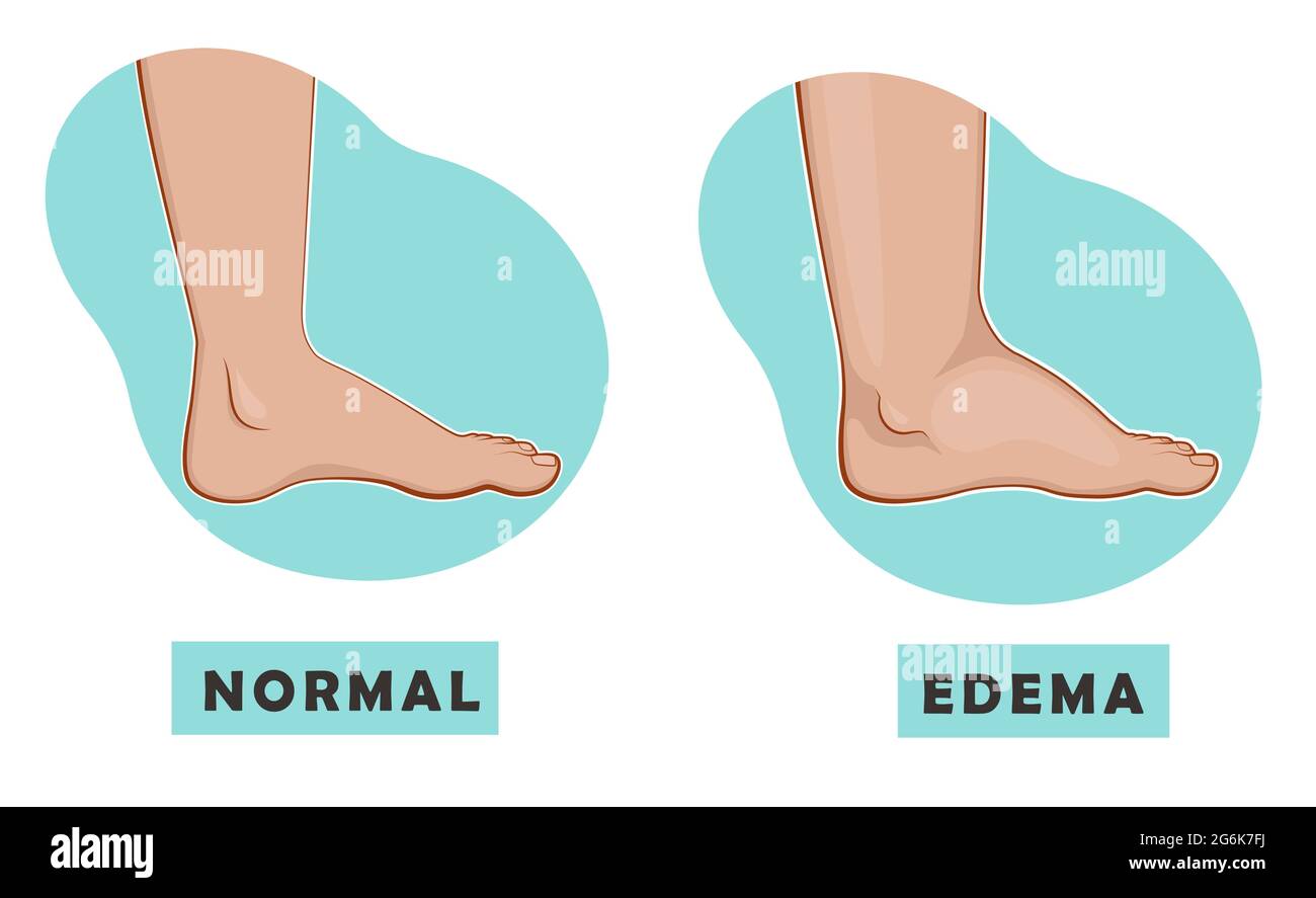 Un piede gonfio e una caviglia e un piede normale. Illustrazione vettoriale della malattia Illustrazione Vettoriale