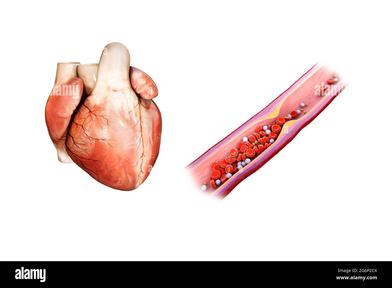 Attacco di cuore, aterosclerosi: La placca di colesterolo si forma in arteria, rotture, le forme di coagulo di sangue e l'arteria bloccata, illustrazione Foto Stock