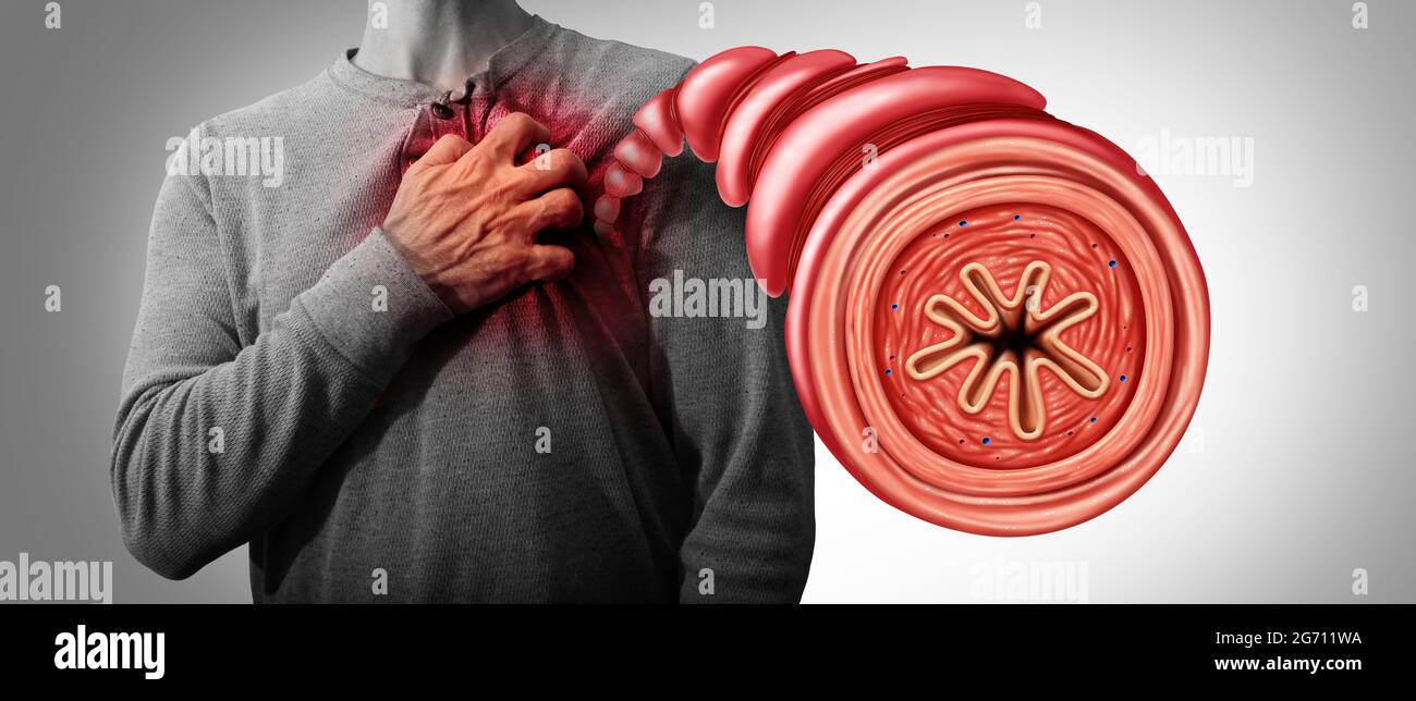 Attacco di asma come tubo bronchiale malsano che soffre di un broncospasmo con un problema di respirazione ristretta causato dal muscolo respiratorio. Foto Stock