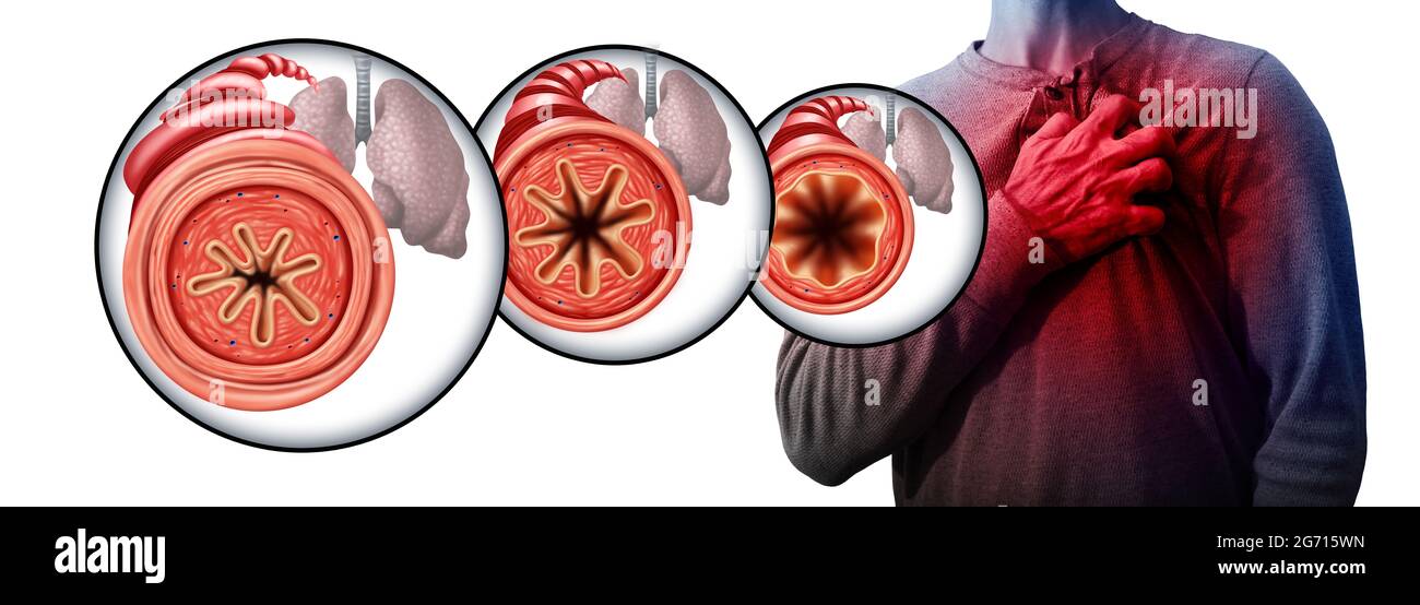 Asma e dolore toracico come tubo bronchiale malsano che soffre di un broncospasmo con una muscolatura ristretta. Foto Stock